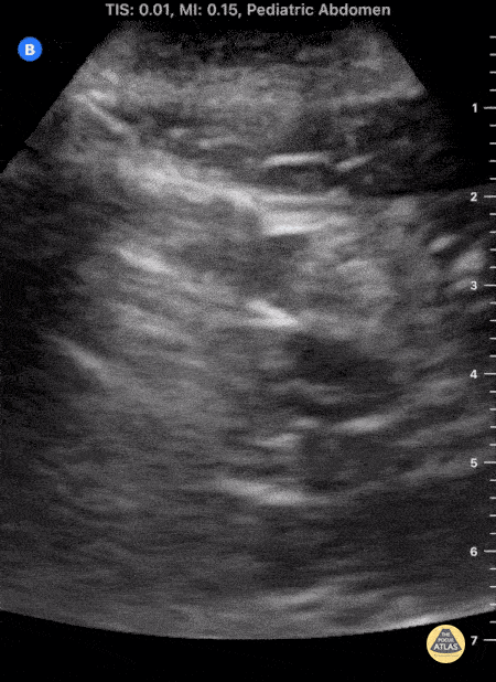 Peds-Gastrointestinal - Pediatric Acute Appendicitis