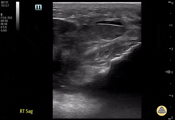 Musculoskeletal - Distal Quadriceps Muscle Rupture