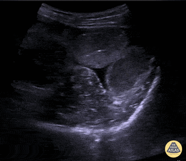 Bowel-GI - SBO Demonstrating To-and-Fro Peristalsis