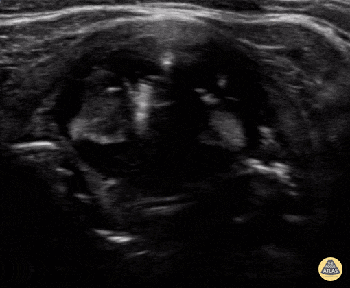 Peds-Lung - Esophageal Intubation
