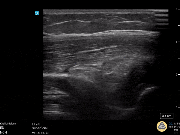 Peds-MSK - Posterior fat pad