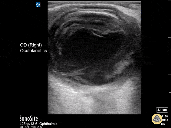 Orbital - Orbital Endophthalmitis