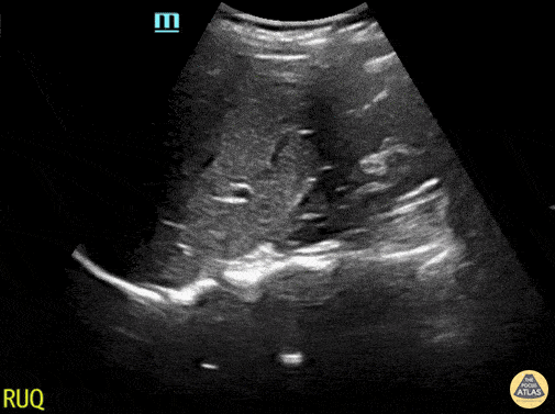 Peds-Trauma - Normal RUQ Evaluation