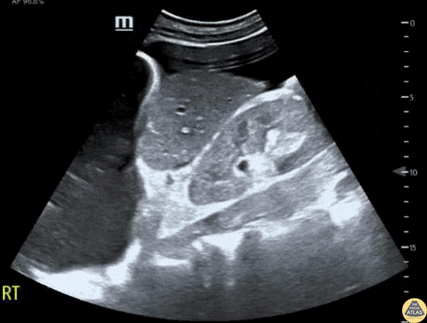 Trauma - Pleural and Peritoneal Fluid in EFAST Exam