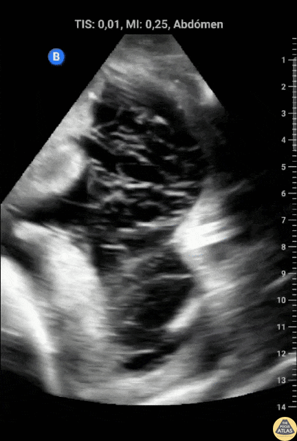 Bowel-GI - Ascites With Spider Web Sign