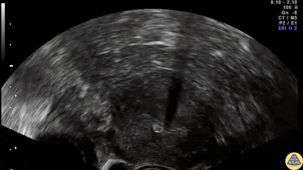 OB/Gyn - US Confirmation of Appropriate IUD Location