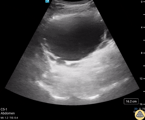 Renal/GU - Bladder Diverticula