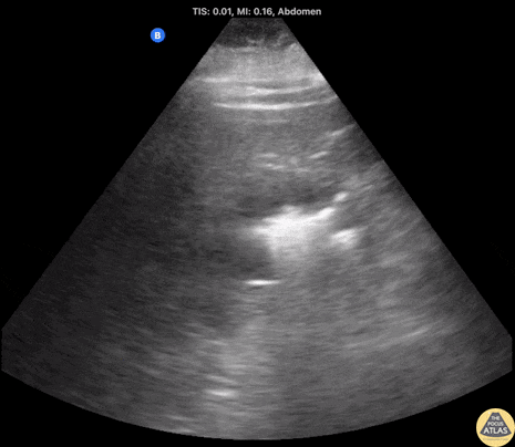 Renal/GU - Right Sided Emphysematous Pyelonephritis