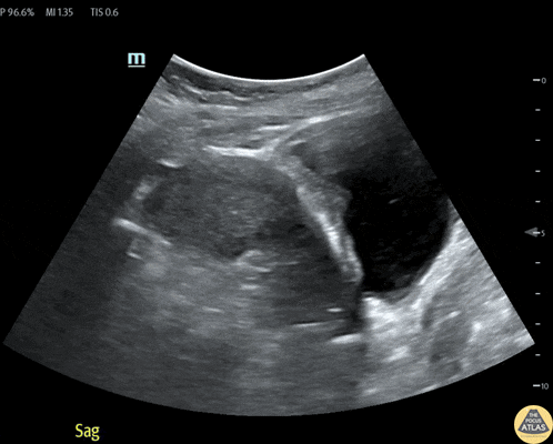 OB/Gyn - Caesarean Section Scar Ectopic Pregnancy