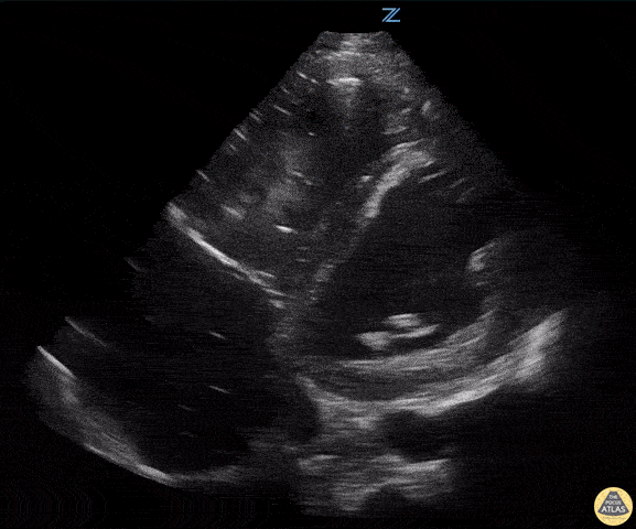 Left Ventricular Dysfunction - Biventricular Failure