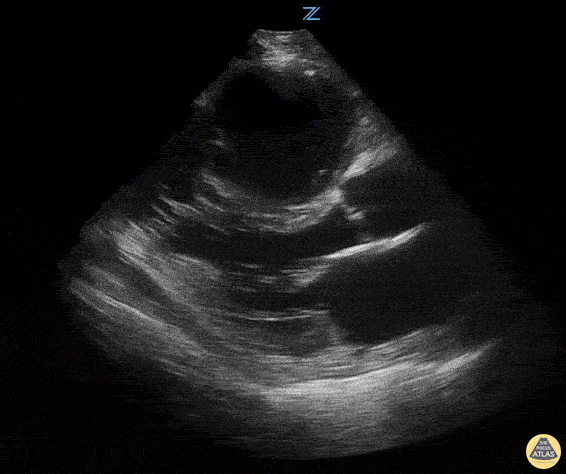 Right Ventricular Dysfunction - RV Failure