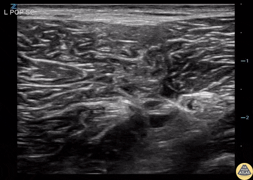 Nerve Block Gallery - Left Popliteal Sciatic Nerve Block