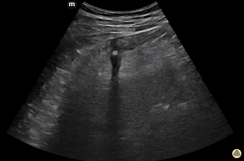 Bowel-GI - Acute Diverticulitis