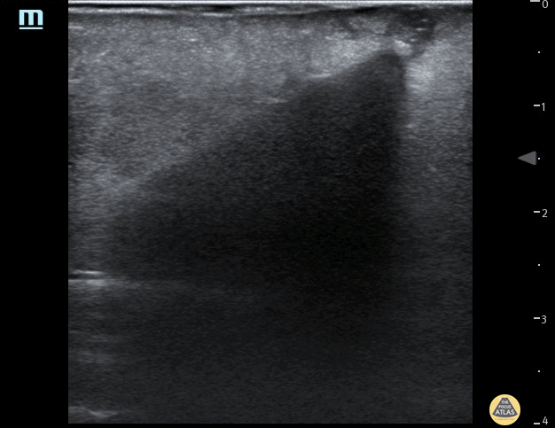 Soft Tissue - Foreign Body - Wooden Cocktail Stick