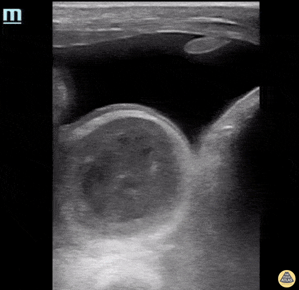 Bowel-GI - Inguinal Hernia with Bowel and Bladder Involvement