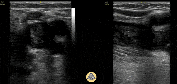 Vascular - Free Floating DVT