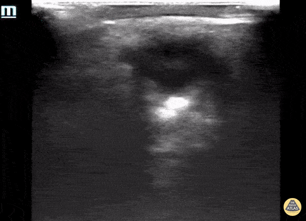 Orbital - Phthisis Bulbi secondary to end stage eye disease