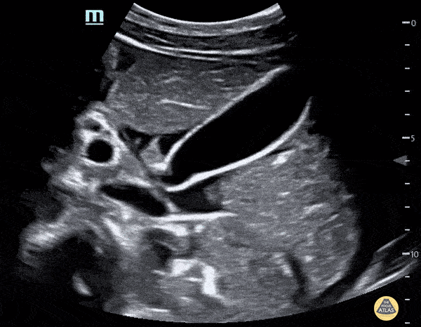 Bowel-GI - Ascites in Pregnancy