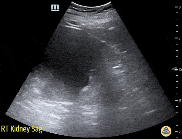 Renal/GU - Large Renal Cysts