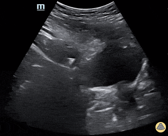 Renal/GU - UVJ stone with ureteral dilation