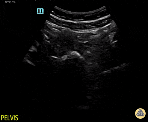 Peds-Trauma - Normal Pelvic Anatomy