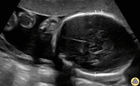 OB/Gyn - Biparietal diameter (BPD) measurement in a 26-week pregnancy.