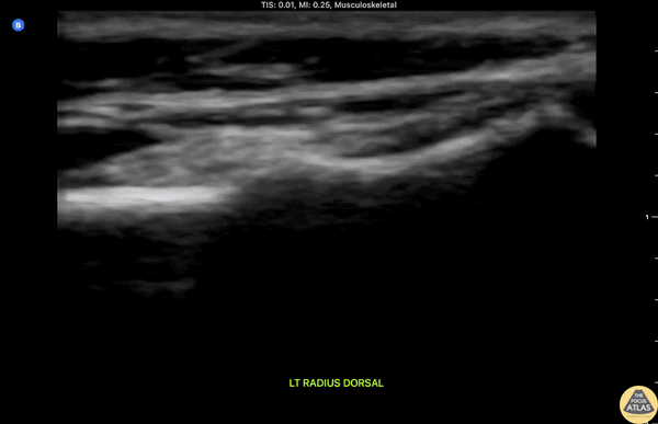 Peds-MSK - Distal Radius Buckle Fracture