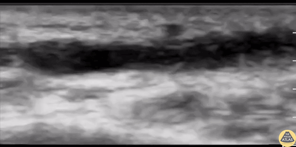 Vascular - Upper Extremity DVT in a 32 y/o female [1/2]