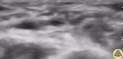 Vascular - Upper Extremity DVT in a 32 y/o female [2/2]