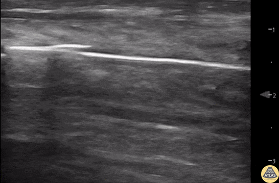 Musculoskeletal - Normal Knee US in TKA Patient