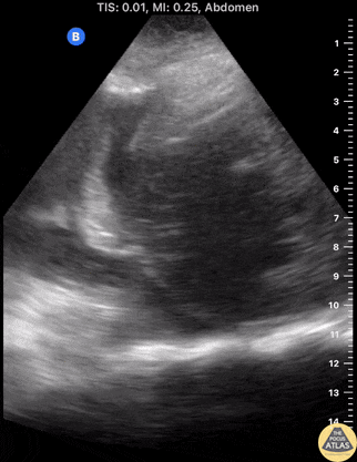 Biliary - Pyogenic Liver Abscess with Pleural Effusion