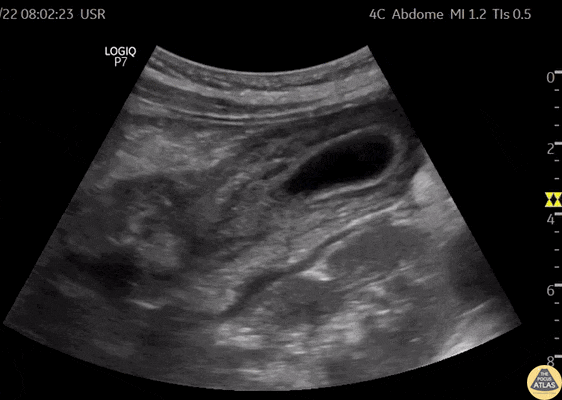 Biliary - Thick Walled Gallbladder in Dengue Fever (Long Axis) [1/2]