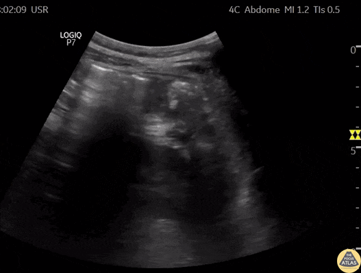 Biliary - Thick Walled Gallbladder in Dengue Fever (Short Axis) [2/2]
