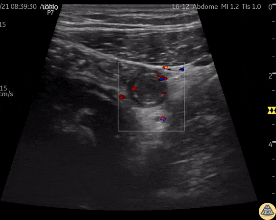 Bowel-GI - "Ring of Fire Sign" in Appendicitis