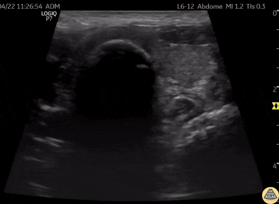 Pulmonary - Snowstorm Sign in Endotracheal Intubation