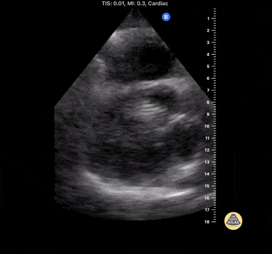 Other Cardiac Pathology - Migrated Venous Stent Traversing Tricuspid Valve