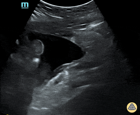 Peds-Trauma - Positive (abnormal) Pelvic View