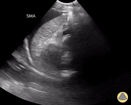 Peds-Trauma - Free Fluid in LUQ