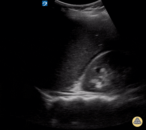 Peds-Trauma - eFAST Positive RUQ