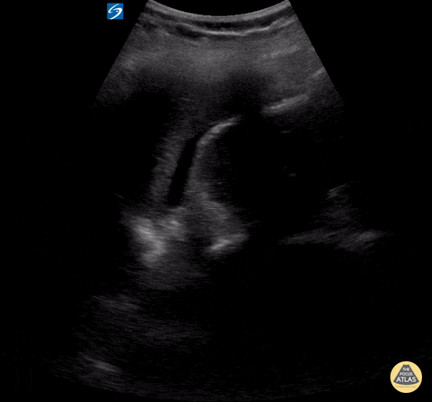 Peds-Trauma - eFAST Positive LUQ