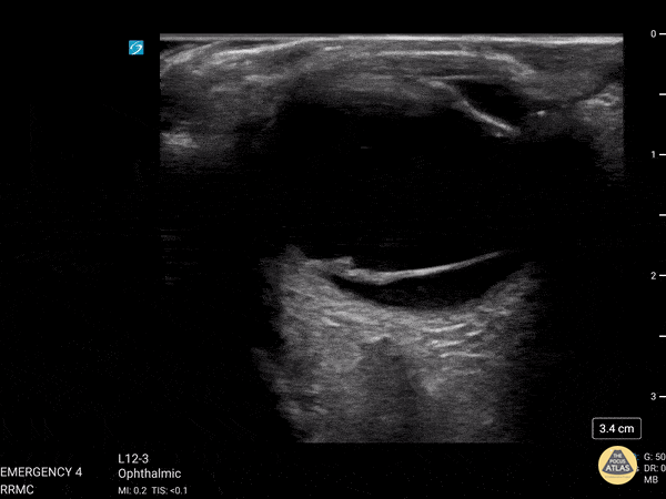 Orbital - Vitreous Detachment