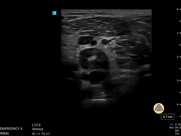 Vascular - Popliteal DVT