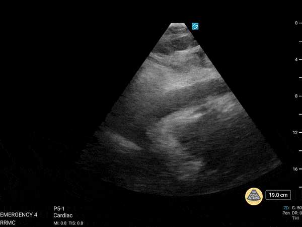 Pericardial Disease - Cardiac Tamponade Found During RUSH Exam