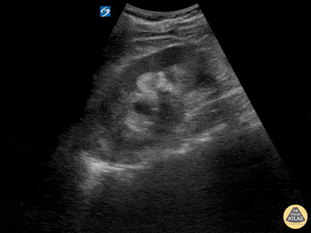 Renal/GU - Moderate Hydronephrosis from Nephrolithiasis