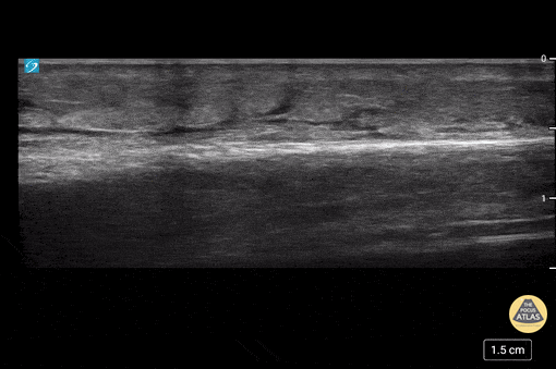 Soft Tissue - Cobblestoning in Cellulitis
