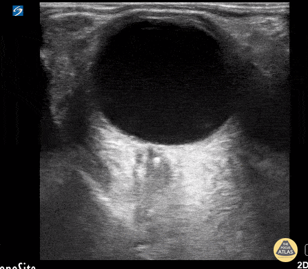 Orbital - Central Retinal Artery Occlusion