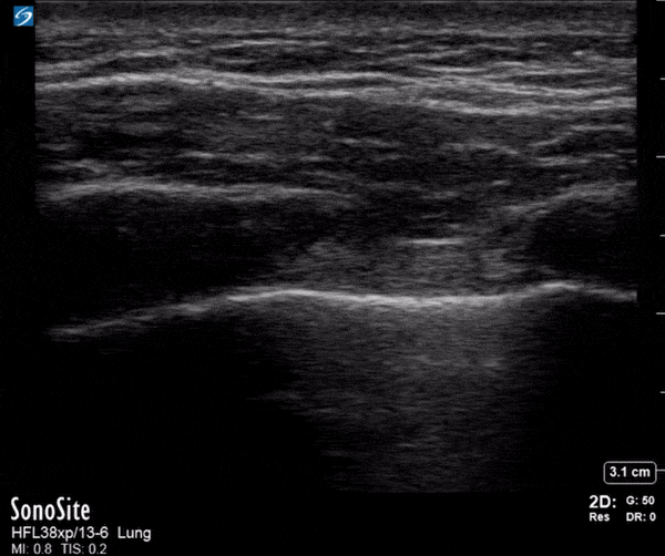 Trauma - Normal Lung Sliding - FAST