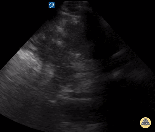 Trauma - Normal LUQ FAST View