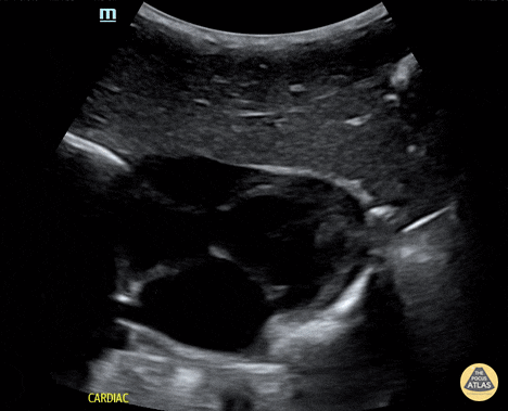 Trauma - Normal subxiphoid evaluation