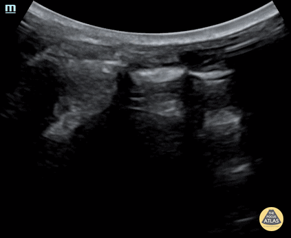 Trauma - Normal Lung Sliding